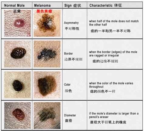 三星痣長怎樣|痣也可能会癌变！长在 3 个地方要注意